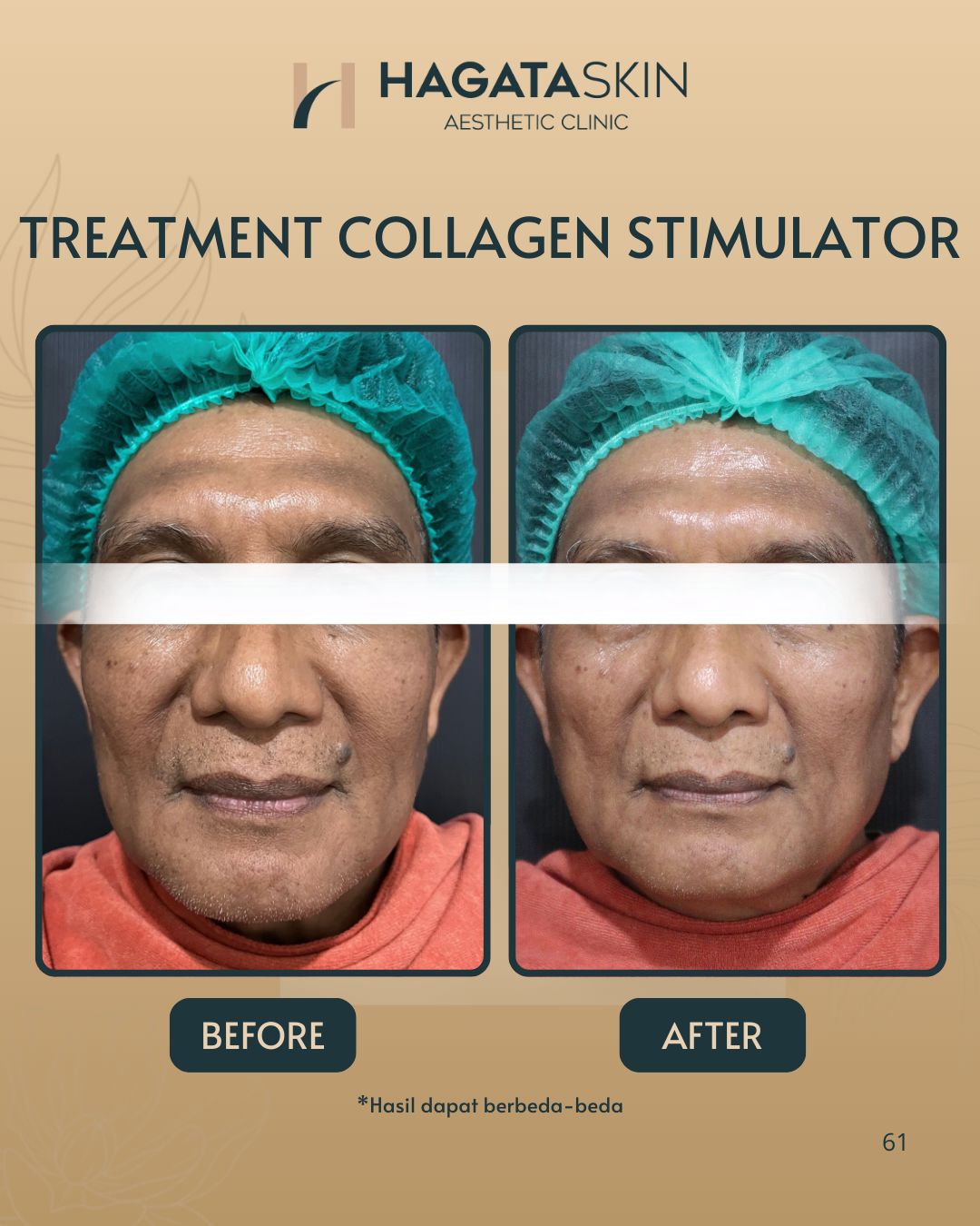 BEFORE AFTER COLAGEN STIMULATOR
