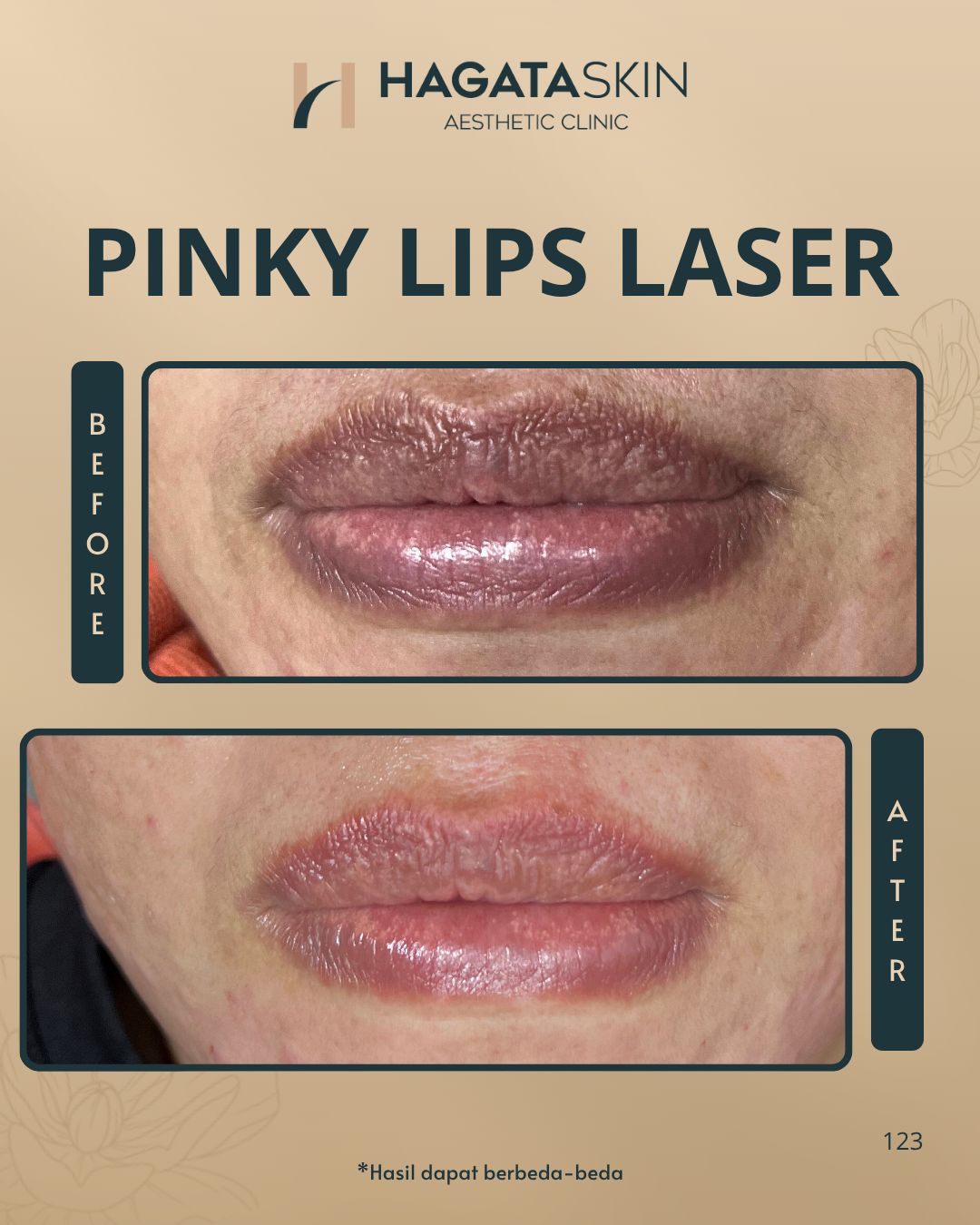 BEFRE AFTER LIPS LASER