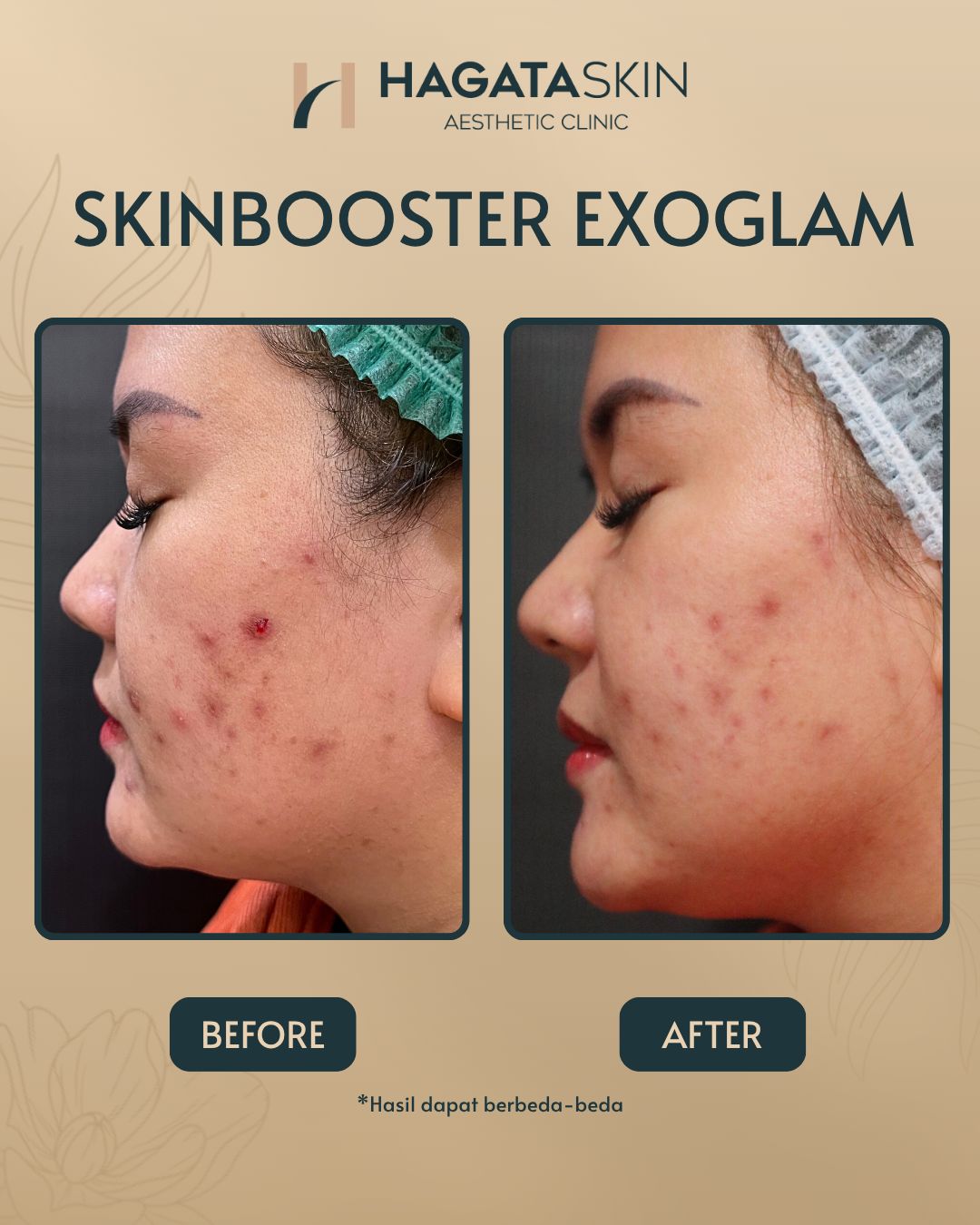 BEFRE AFTER SKINBOOSTER