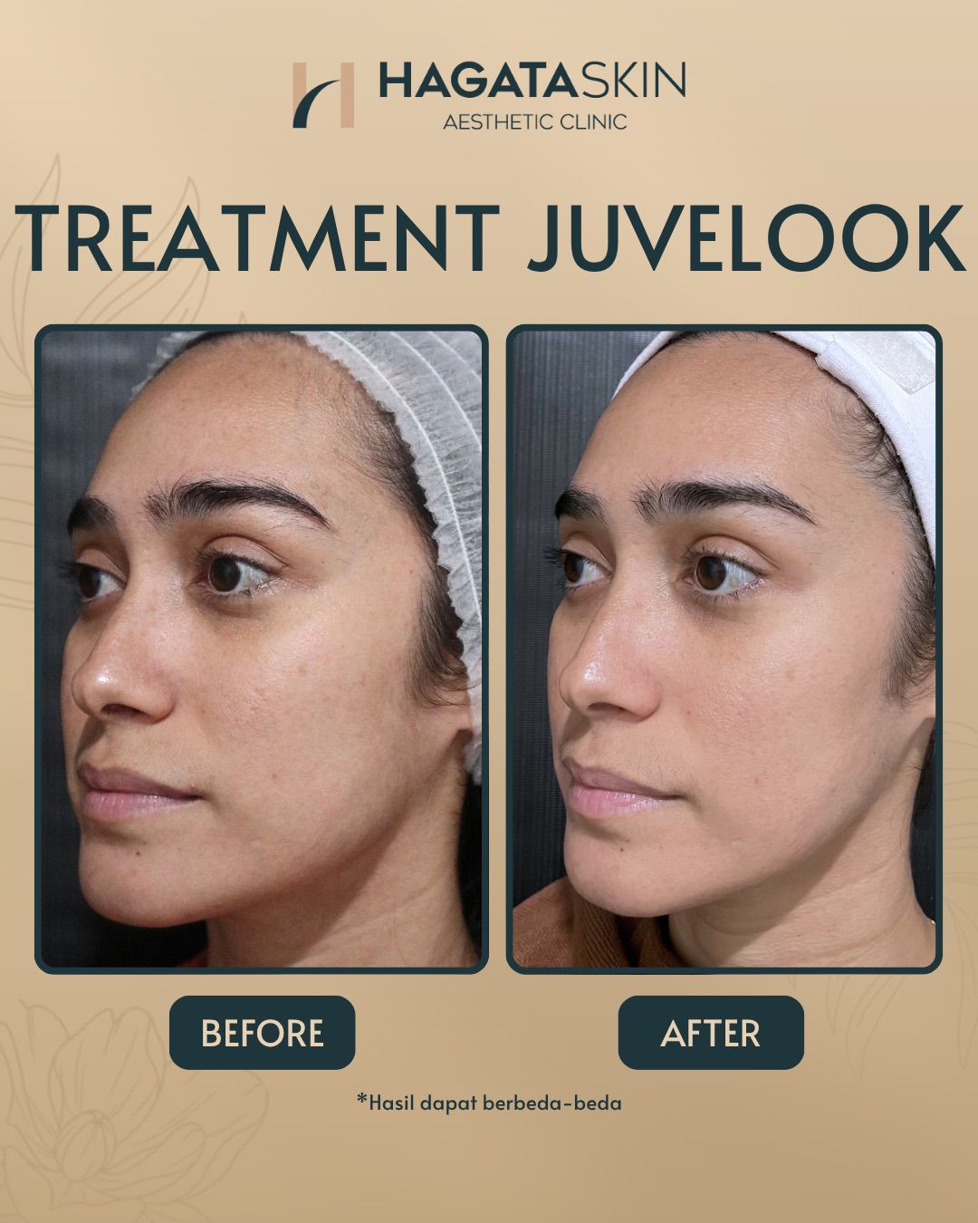 BEFRE AFTER TREATMENT JUVELOOK
