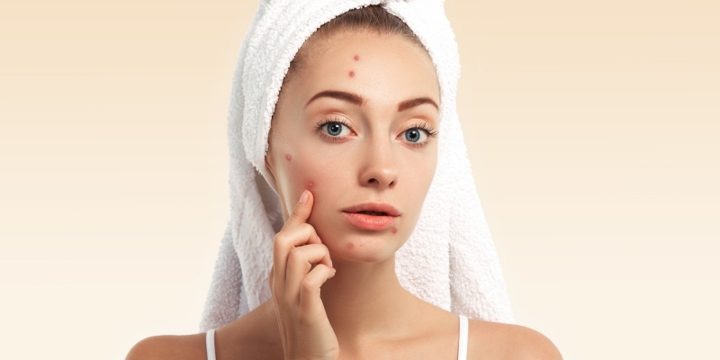 Cara Menghilangkan Bekas Jerawat