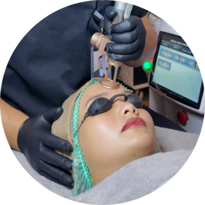 Treatment - Laser CO2 (Original) - 2 Treatment - Laser CO2 (Original)