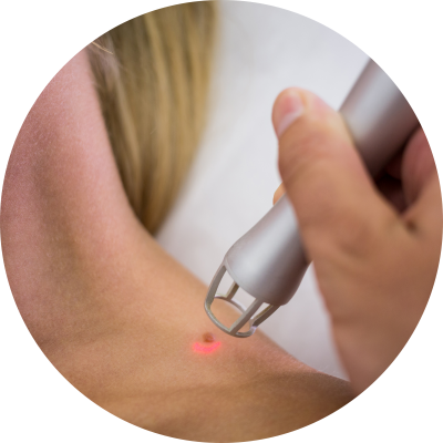 Treatment - Laser Skintag Treatment - Laser Skintag