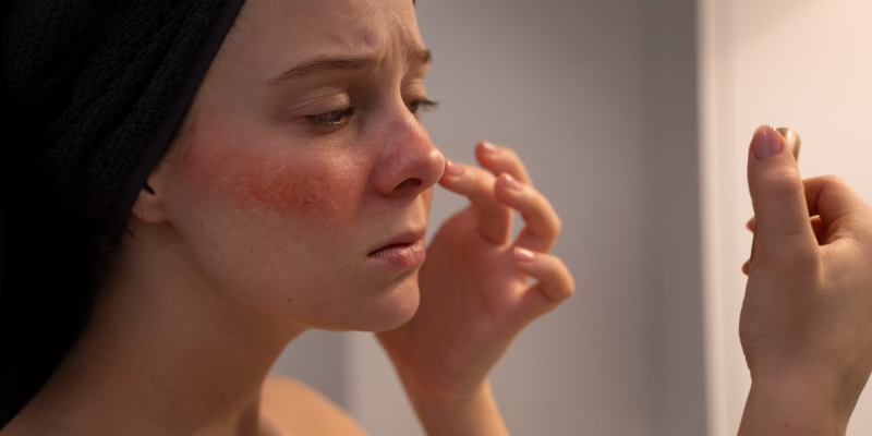 Ciri Ciri Kulit Sensitif & Cara Mengatasi Kulit Sensitif