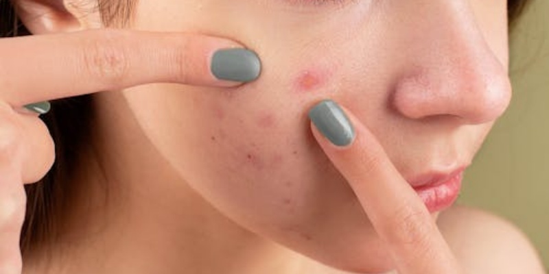 Cara Mengatasi Bekas Jerawat Kemerahan