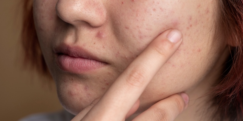 cara menghilangkan bruntusan di wajah