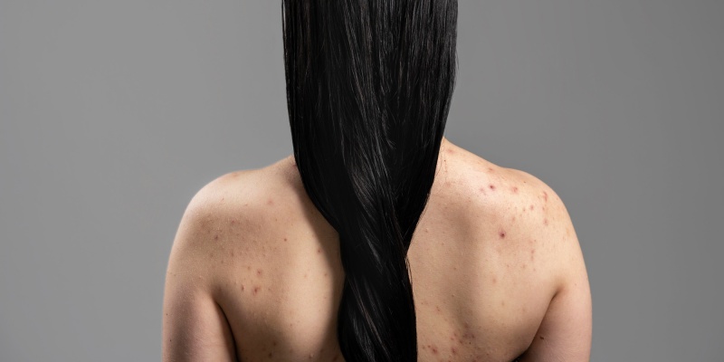 cara menghilangkan jerawat punggung 