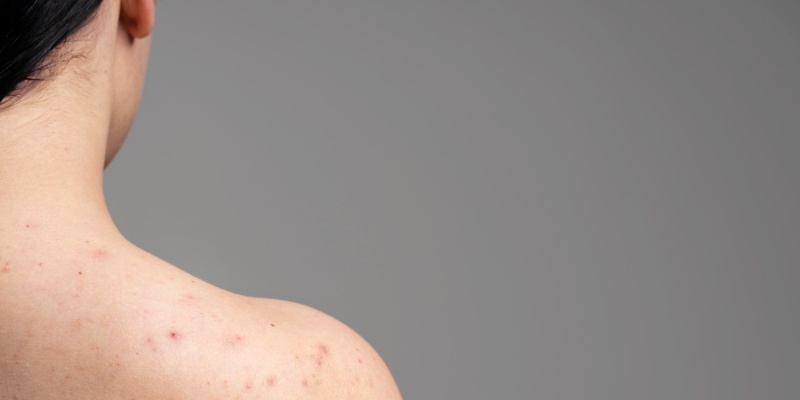 cara menghilangkan jerawat punggung